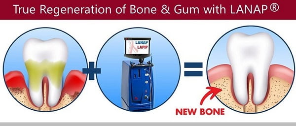 Dental bone augmentation with LANAP regenerative dentistry