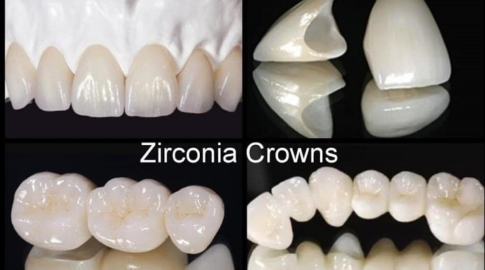 Full-Contour and Layered Zirconia Crowns