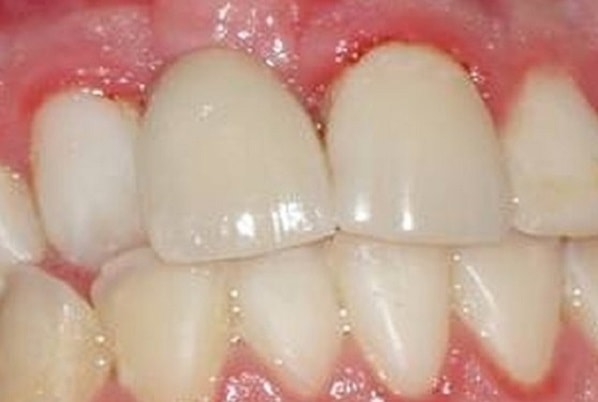 Gum Problems Are a Warning Sign