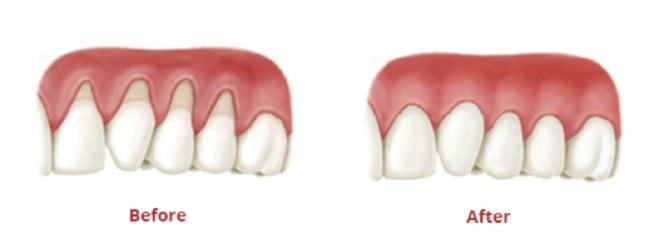 Gum graft surgery