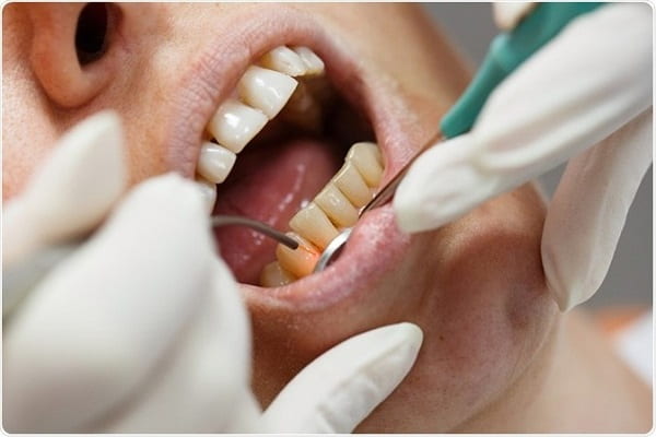 Laser Therapy around Ailing Failing Dental Implants