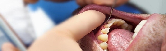 Laser treatment