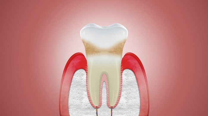 Receding gum