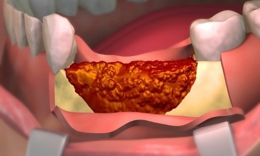 SURGICAL TREATMENT FOR BONE LOSS