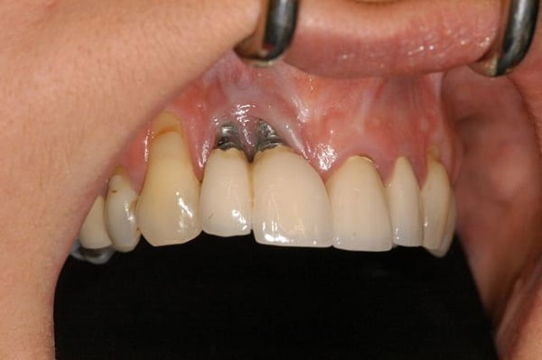 Severe Gum Recession Means Bone Loss