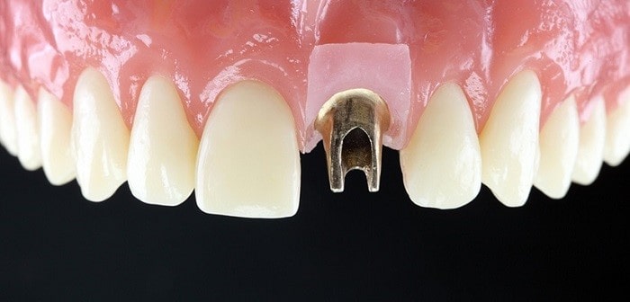 Types of implant crowns