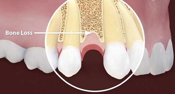 WHAT CAUSES BONE LOSS
