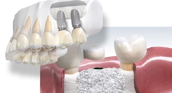 WHY CONSIDER DENTAL BONE GRAFT SURGERY