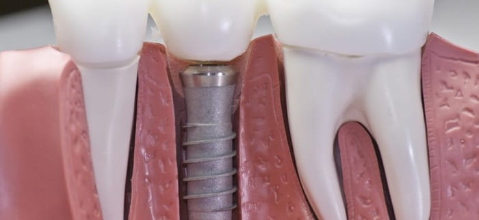 What are Dental Implants