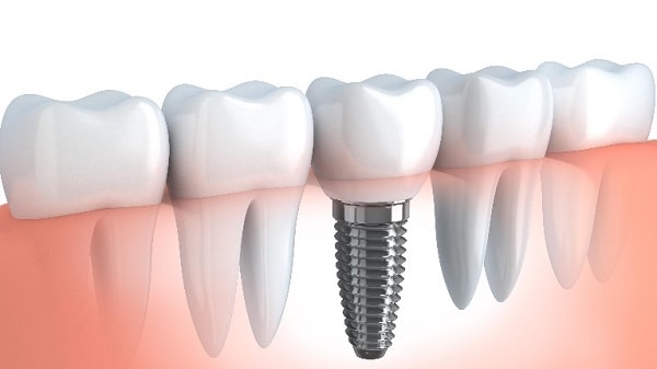What is dental implant