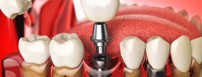 Am I a candidate for Dental Implants