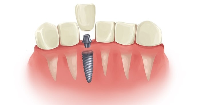 Dental implant specialist in Laguna Niguel, Orange County
