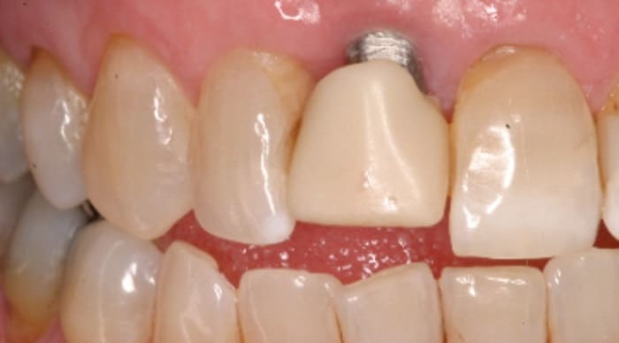 Reasons For Having Dental Implant Problems