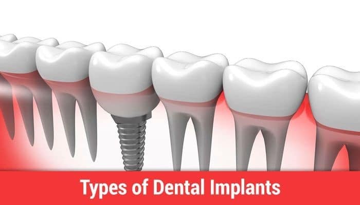 What are the Treatment Options for Dental Implants