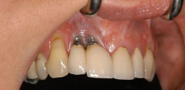 What is causing the ailing and failing of dental implant