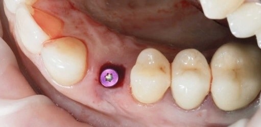 Why Do Dental Implants Fail