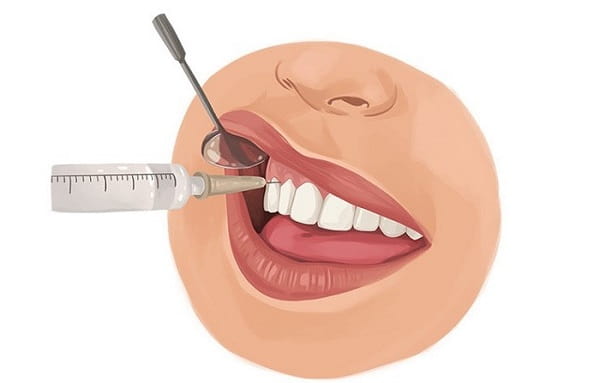 Local anesthesia