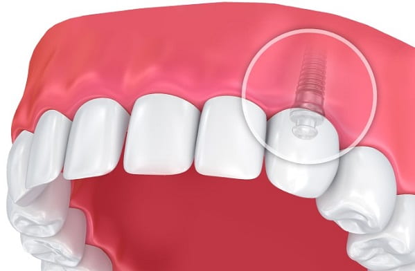 What Is a Dental Implant