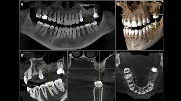 When are 3D scans used