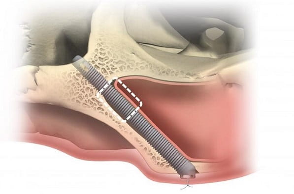 Why do you need zygomatic dental implants