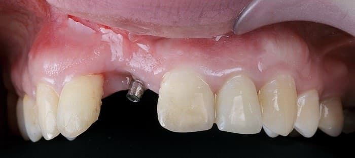 Causes of dental implant failure