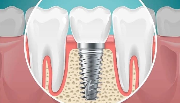 Dental Implant Procedure