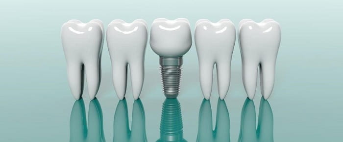 Dental Implant and Temporary Crown