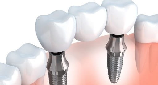 Fixed Multiple Tooth Replacement