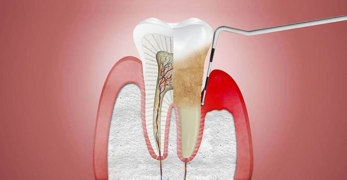 Gum disease treatments