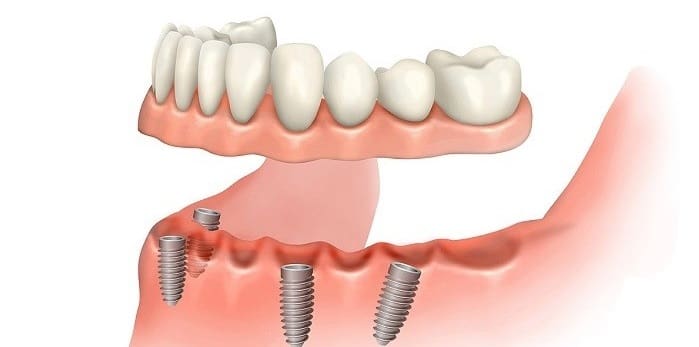 Removable Implant-Supported Tooth Replacement
