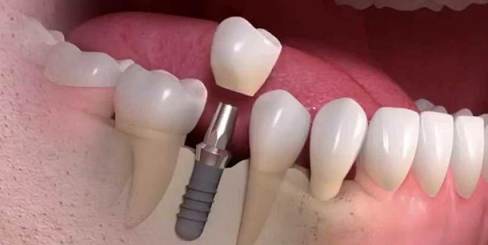 What are dental implants