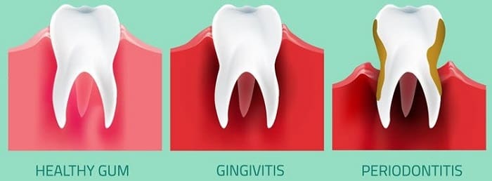 What are the stages of periodontal disease