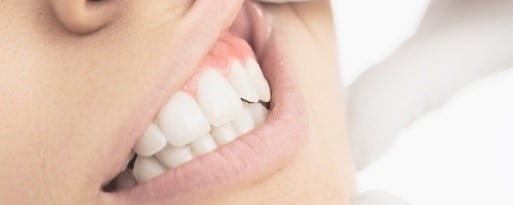 What are the symptoms of gum disease