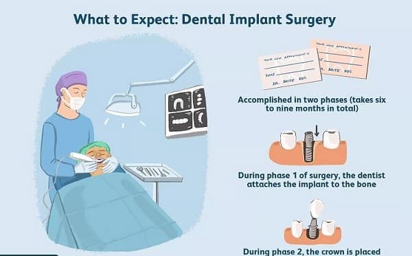 Dental implant is a specialty