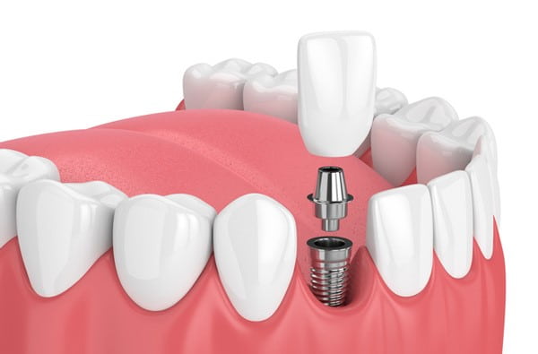 The benefits of implant dentistry