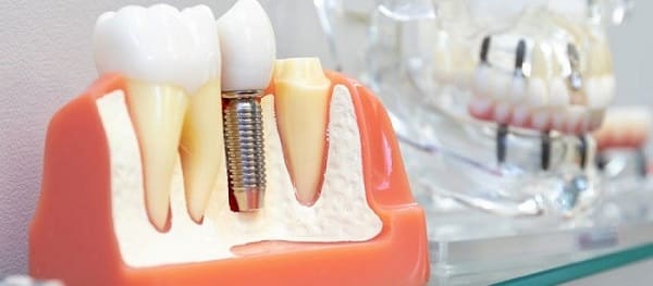 What is dental implant