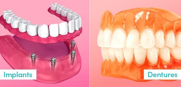 Dental implant vs denture