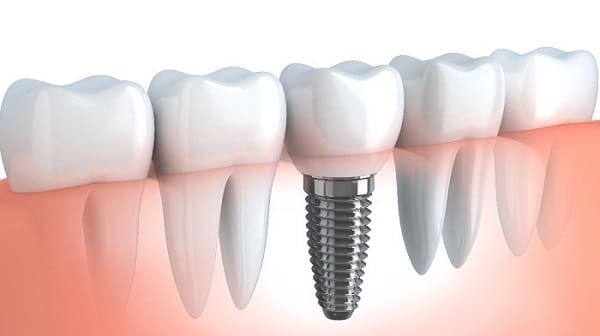 Dental implants