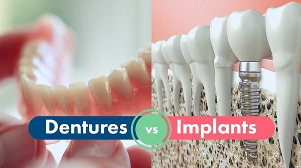 What to Consider When Choosing Dental Implants vs Dentures