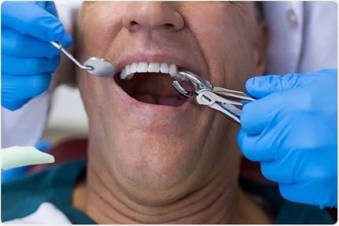 Dental Extraction Procedure