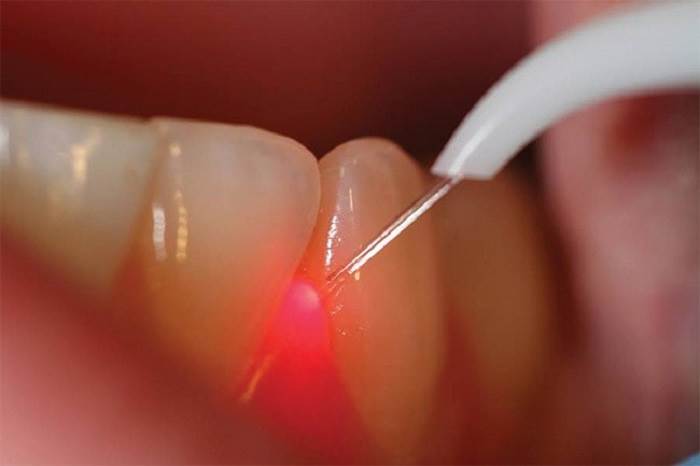 How Are Lasers Used In Periodontal (Gum) Treatment