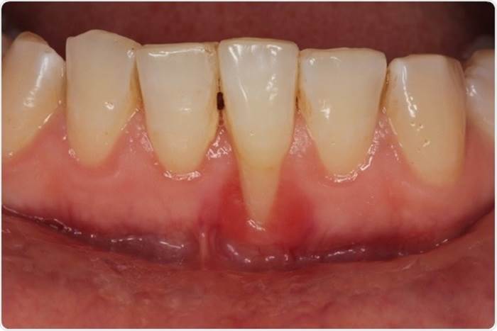 Symptoms of gum recession in pregnancy