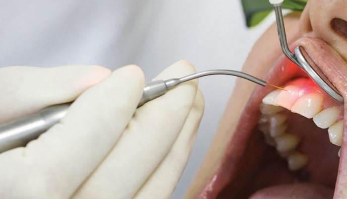 Teeth and gum surgery with lasers