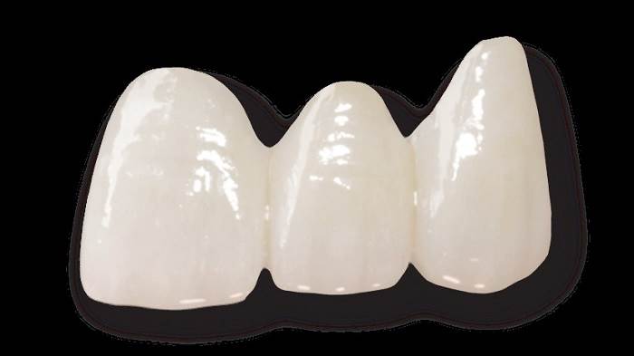 What are ceramic dental bridges