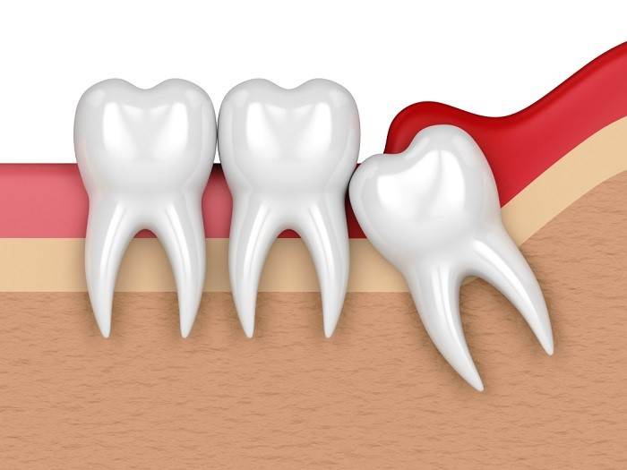 When Is Tooth Extraction Necessary