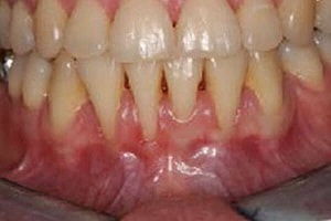 candidates for gum surgery min