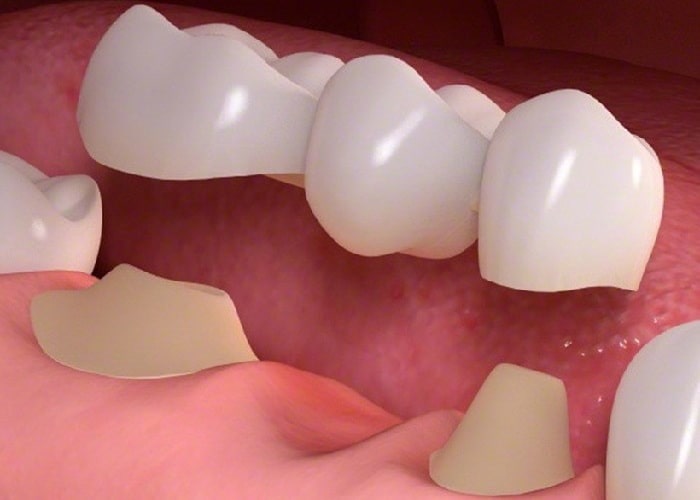 Crown placement