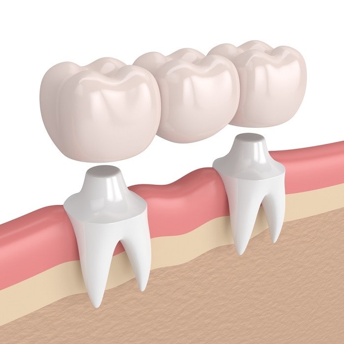material for dental bridge