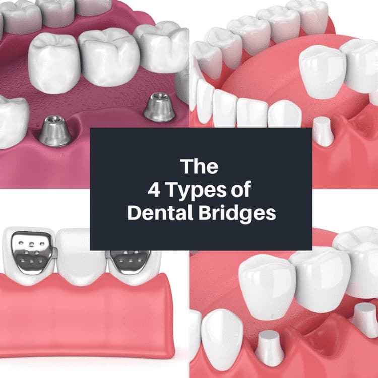 types of Dental Bridges