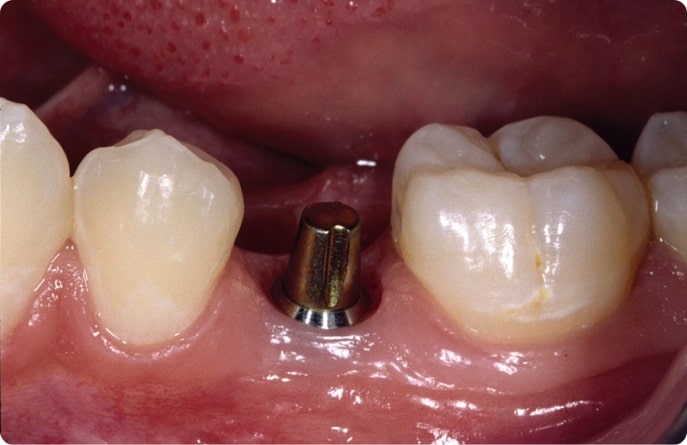 Abutment for Dental implant